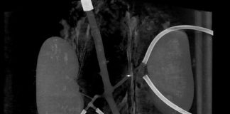 Миллироботы смогут разрушать тромбы и пробивать себе путь через кровеносные сосуды Миллироботы смогут разрушать тромбы и пробивать себе путь через кровеносные сосуды