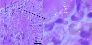Учёные обнаружили микропластик в мозге, но его влияние на здоровье пока неясно | New-Science.ru Учёные обнаружили микропластик в мозге, но его влияние на здоровье пока неясно | New-Science.ru